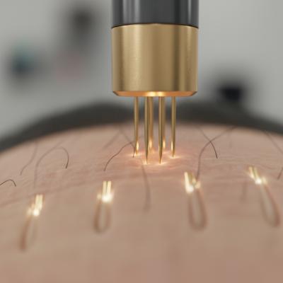 Radiofrequência Microagulhada Capilar: O Guia Definitivo para Reverter a Queda de Cabelo